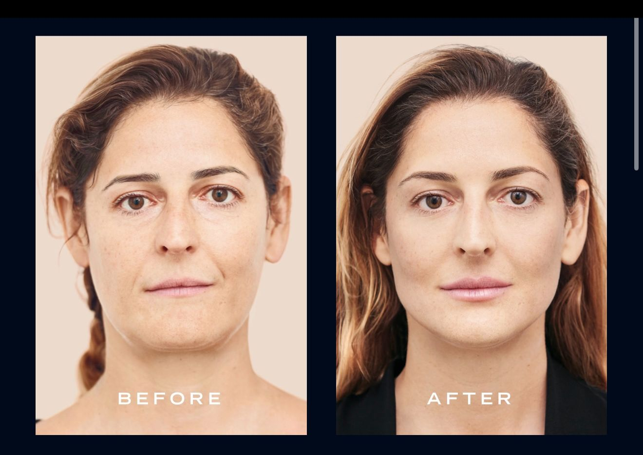 Antes e depois VECTA